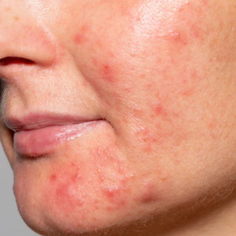 Acne & Scarring — common symptoms