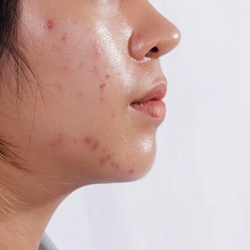 Acne & Scarring — treatment goal
