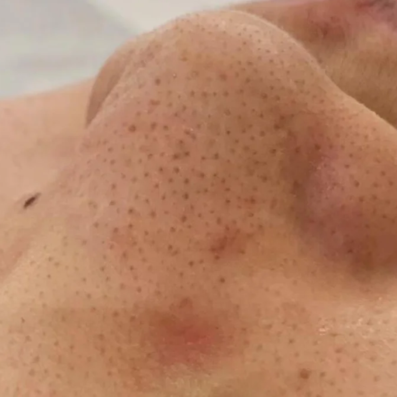 Couperose / Redness — common symptoms