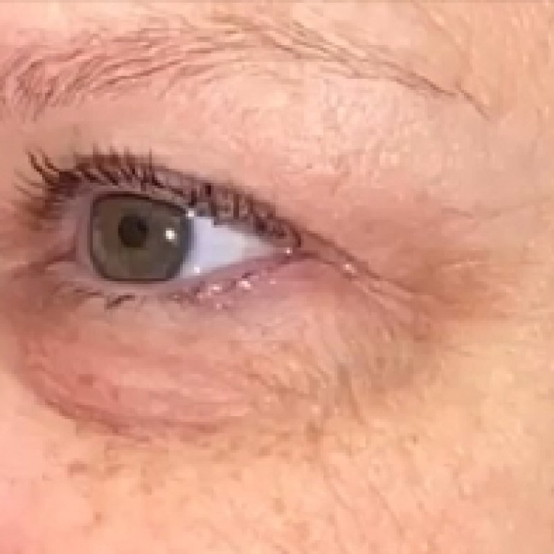 Dark Circles & Puffy Eyes — common symptoms