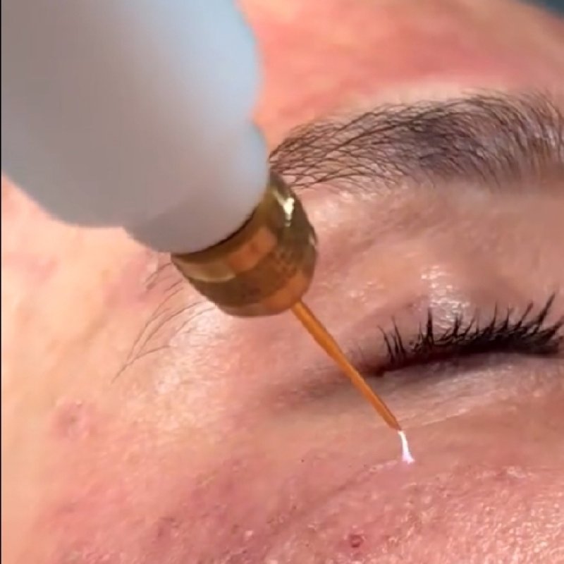 Dark Circles & Puffy Eyes — treatment goal