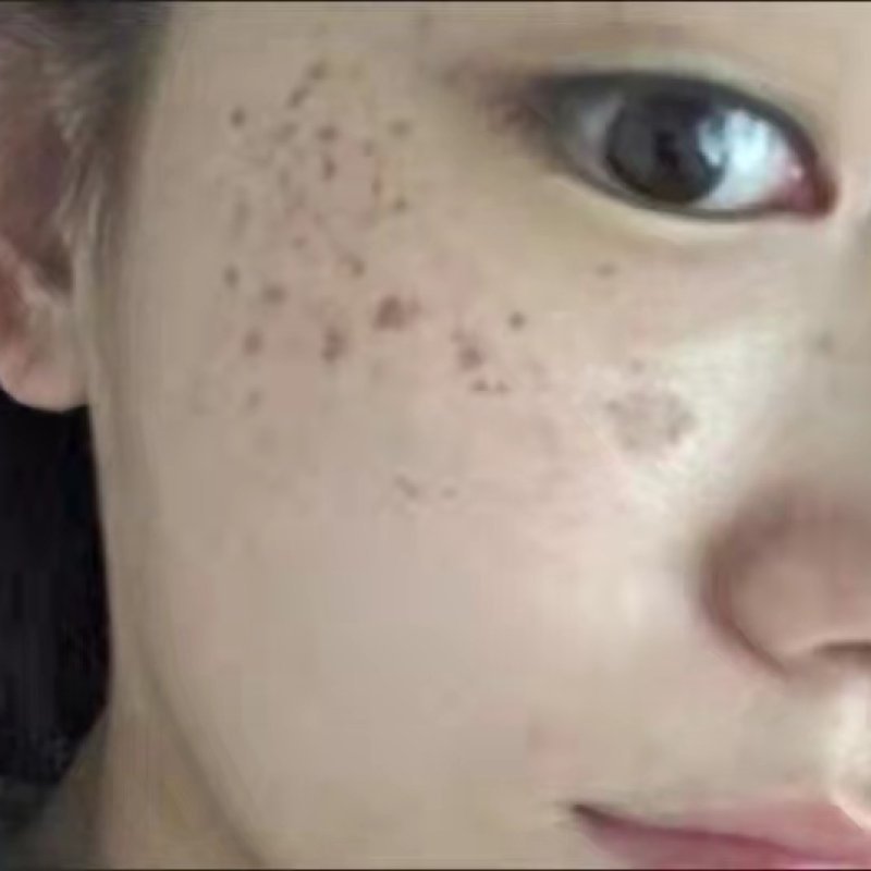 Pigmentation & Melasma — common symptoms